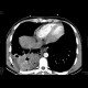 Lung tuberculosis, cavern, endobronchial spread, tree-in-bud: CT - Computed tomography
